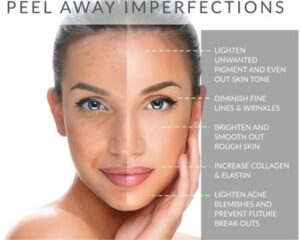 PCA Face Peel